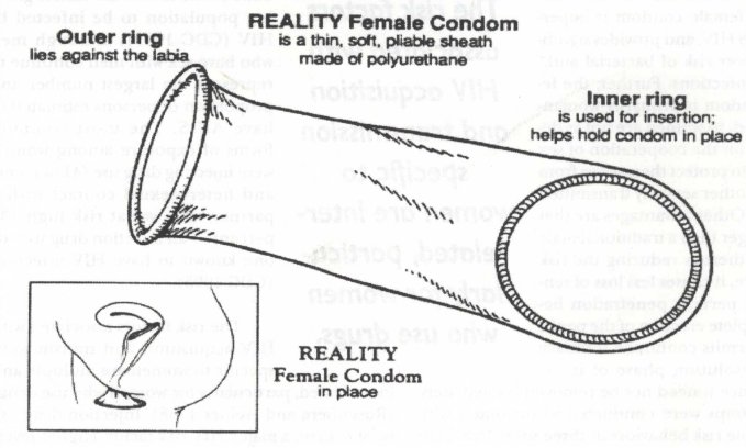 femcondom