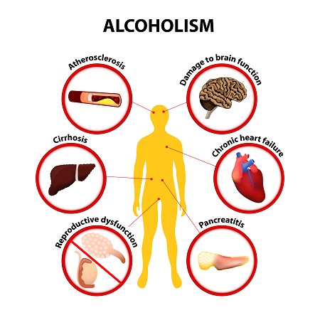 Alcoholism Health Problems: Atherosclerosis, Damage to brain function, Cirrhosis, Chronic heart failure, Reproductive dysfunction, Pancreatitis