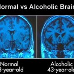 The effects of alcohol on the brain. Normal vs Alcoholic Brain.