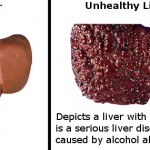 The effects of alcohol on the liver. Healthy and unhealthy liver.