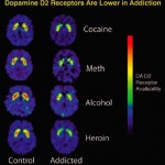 Addiction Brain Scans (Cocaine - Meth - Alcohol - Heroin)