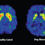 Brain Scan (Healthy Control - Drug Abuser)