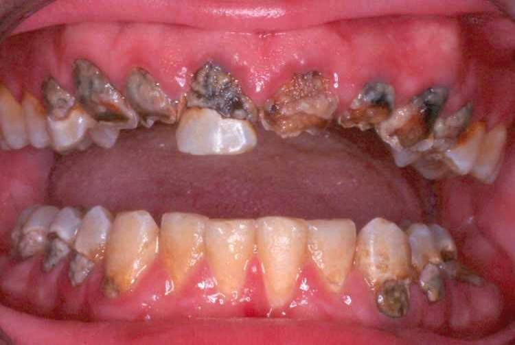 Methamphetamine effects of teeth 2