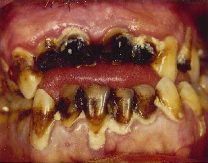 Methamphetamine effects of teeth 3