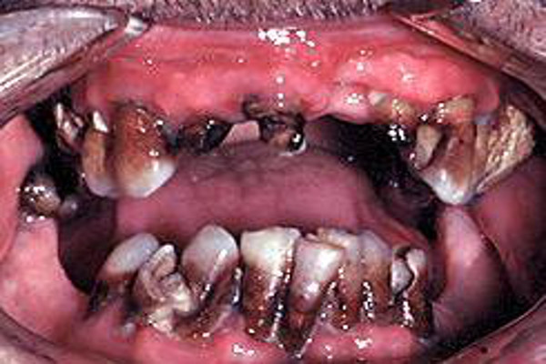 Methamphetamine effects of teeth 4