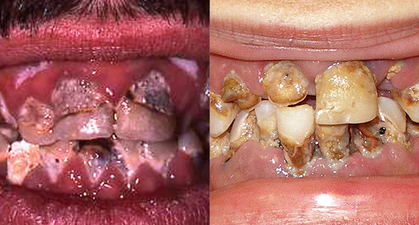 Methamphetamine effects of teeth