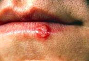 Cold Sores, Herpes simplex (HSV-1), fever blister