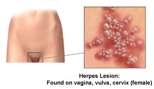 Genital Herpes Female