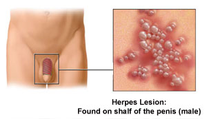 Genital Herpes Male
