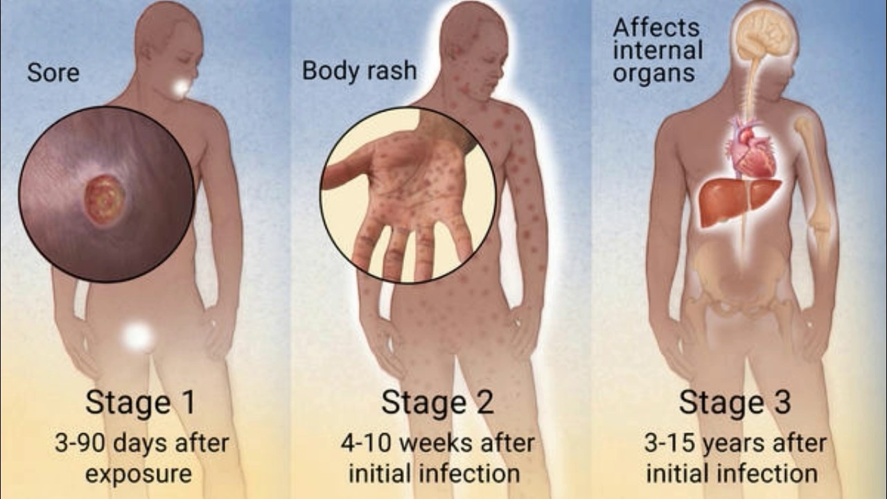 Symptoms of Syphilis